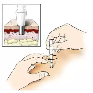 Titánium implantátum talp, három réssel kép